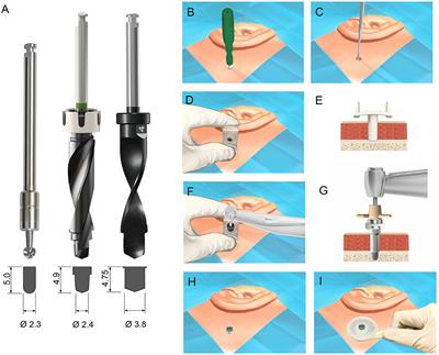 Ex vivo Evaluation of a New Drill System for Placement of Percutaneous Bone Conduction Devices